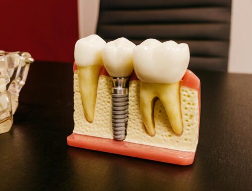 Dental implants with screw on table in clinic
